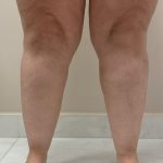 Lipedema2